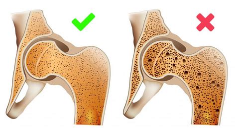 Лечение остеопороза - как избавиться от боли в суставах